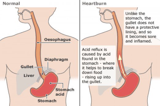  are gastroesophageal reflux disease (GERD) or peptic ulcer disease