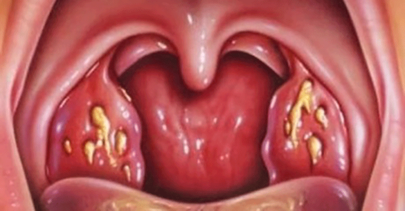 Tonsilitis Throat 106