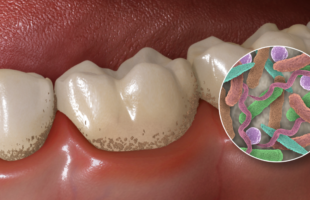 Morning Breath Can Be Deadly. How to Use Food Grade Hydrogen Peroxide to Kill Pathogens