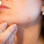 DIY Natural Acne Treatment. It Works Like Magic