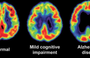 The Phenomenal Hobby that Reduces Alzheimer’s and Dementia by 50%