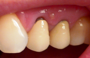 Toxic Teeth: The Most Popular Dental Practice that’s Making You Very Sick